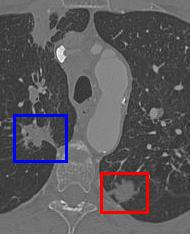A single slice of CT data containing a clinical tumor in the blue box and a synthetic model in the red box.